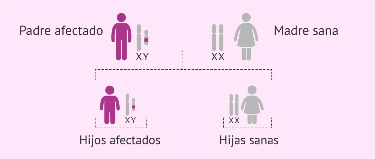 Padre afectado (XY) y madre sana (XX) tienen hijos afectados (XY) y hijas sanas (XX). El cromosoma Y determina el sexo masculino.