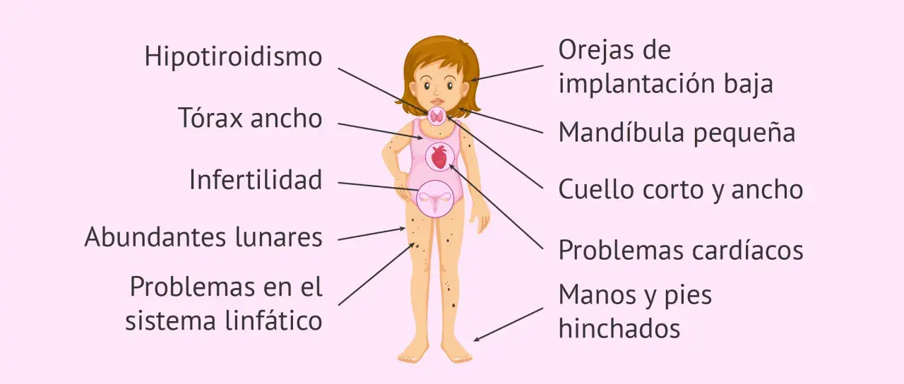 Ilustración de una niña con los **síntomas del síndrome de Turner**: hipotiroidismo, tórax ancho, infertilidad, lunares, problemas linfáticos, orejas bajas, mandíbula pequeña, cuello corto, problemas cardíacos y edema.