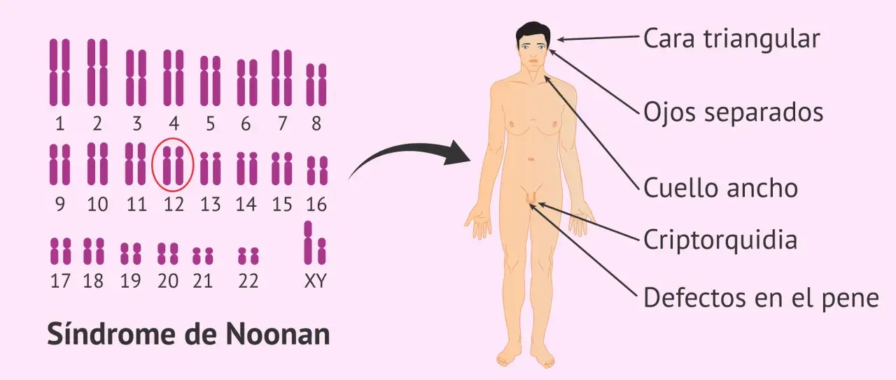 Cariotipo con anomalía en cromosoma 12, asociado a características del síndrome de Noonan: cara triangular, ojos separados, cuello ancho, criptorquidia y defectos en el pene.