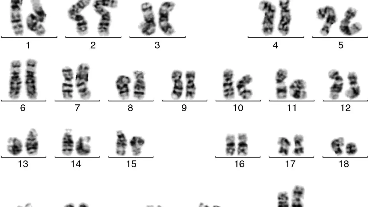 Cariotipo humano con 23 pares de cromosomas, incluyendo los autosomas del 1 al 22 y los cromosomas sexuales X e Y. Un análisis qf pcr revela la estructura de cada par.