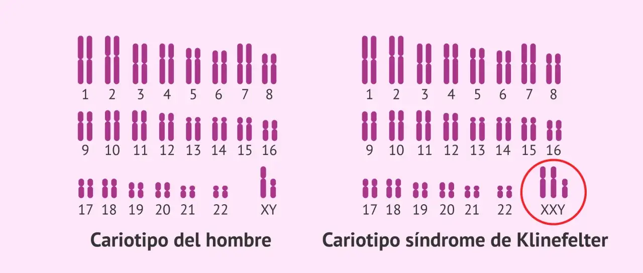 Cariotipo de hombre con cromosomas XY y cariotipo de síndrome de Klinefelter con XXY.