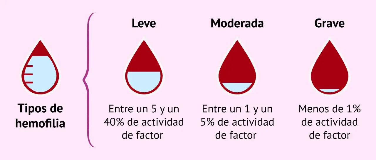Ilustración de tipos de hemofilia: leve (5-40% actividad factor), moderada (1-5%) y grave (<1%).