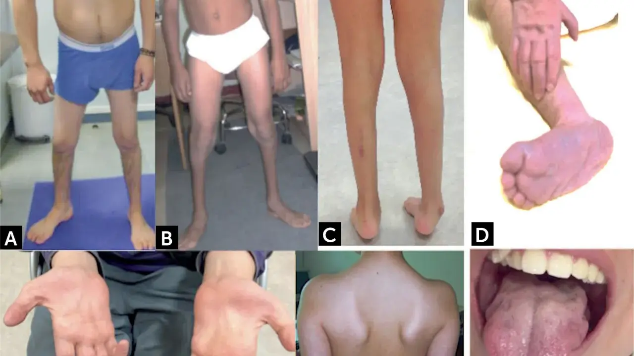 Manifestaciones de atrofia muscular espinal: piernas delgadas (A, B, C), pie equino (D), manos con dedos finos (E), espalda con escápulas prominentes (F) y lengua con fasciculaciones (G).
