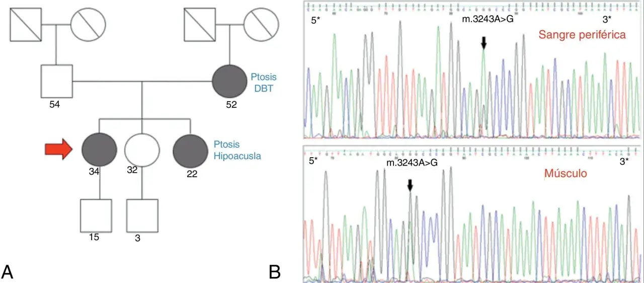 Pedigrí que muestra herencia mitocondrial de ptosis y hipoacusia, junto a electroforesis que confirma la mutación m.3243A>G.
