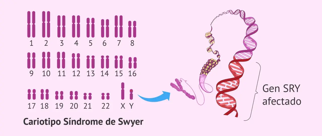 Cariotipo XY con el gen SRY afectado, indicativo del Síndrome de Swyer.