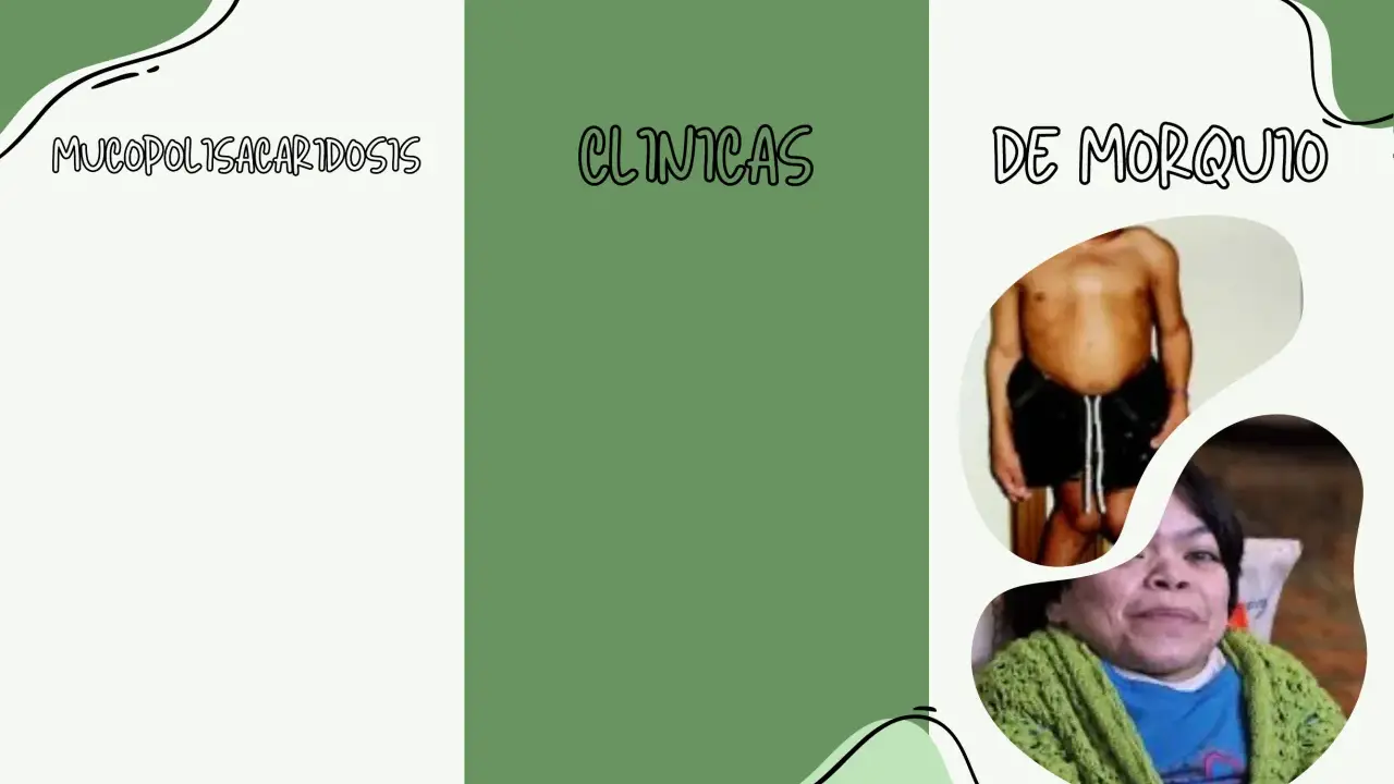 Mucopolisacaridosis: clínicas de Morquio. Imágenes de personas con esta condición.