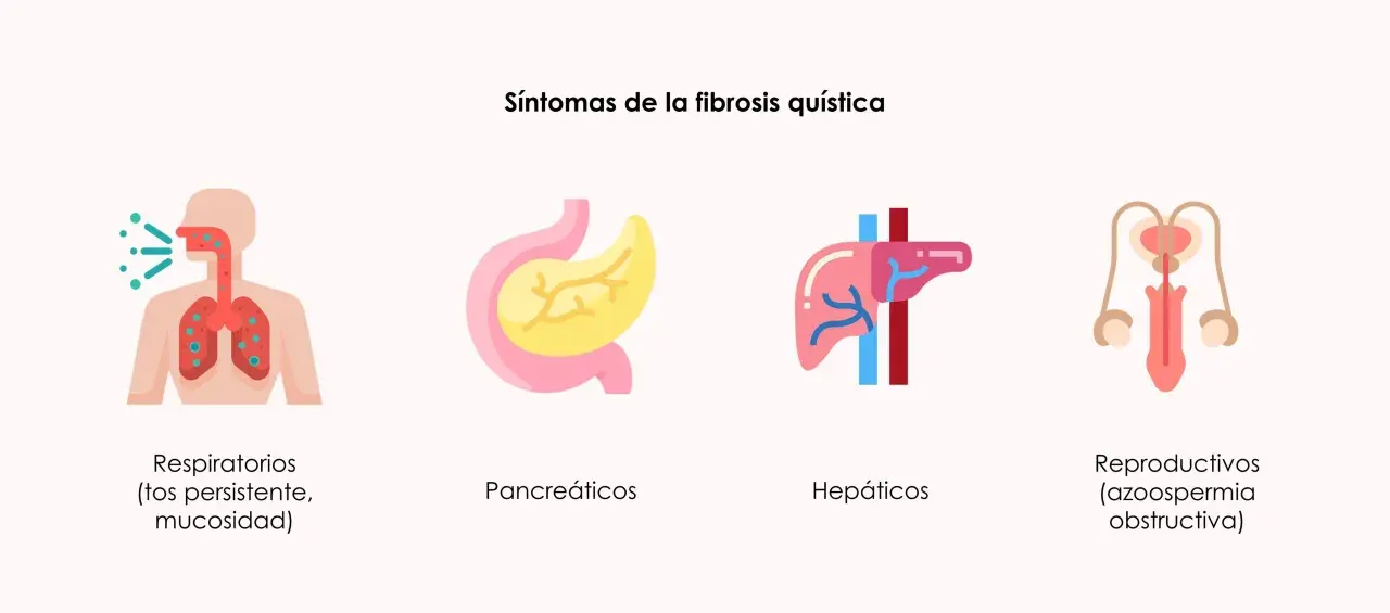 Ilustración de síntomas de fibrosis quística: respiratorios (tos, mucosidad), pancreáticos, hepáticos y reproductivos (azoospermia obstructiva).