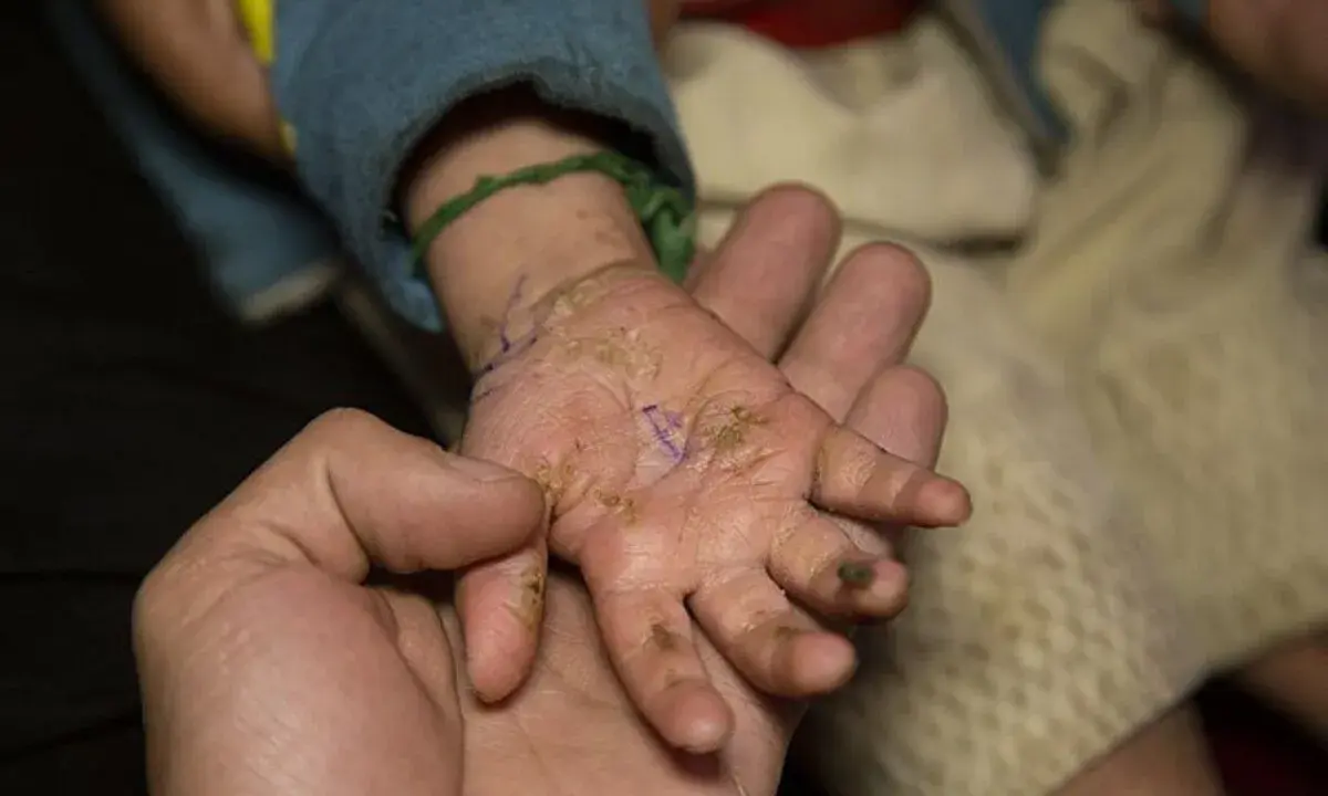 Una mano adulta sostiene la mano de un niño con piel escamosa y seca, mostrando cómo empieza la piel de mariposa.
