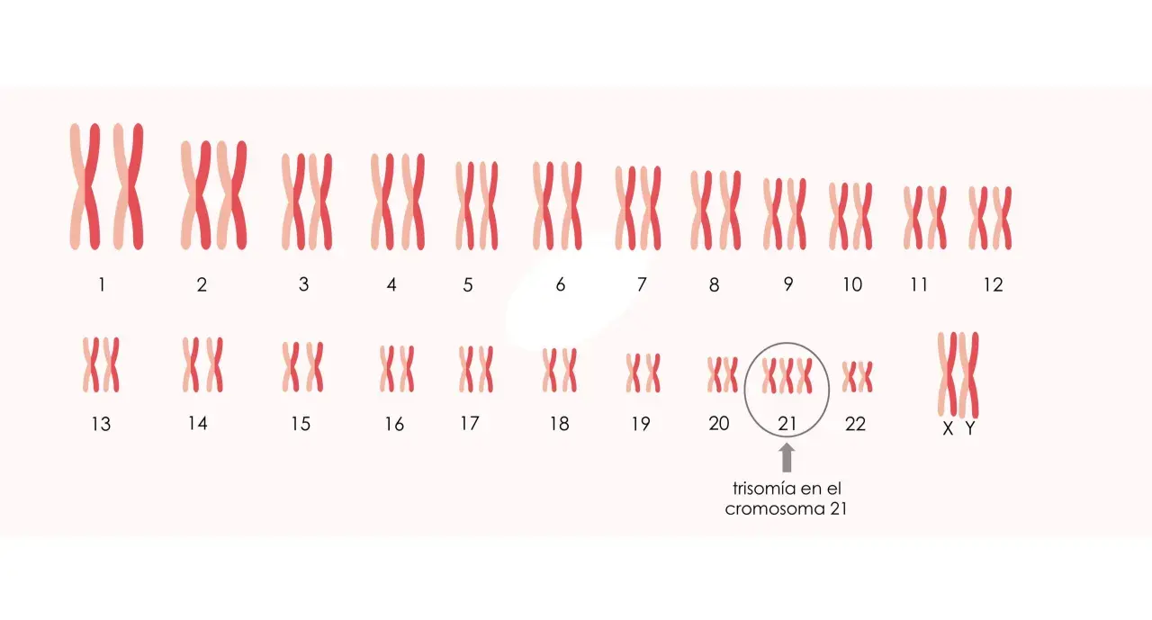 Cariotipo que muestra trisomía en el cromosoma 21, indicando cuántos cromosomas tiene un Down.