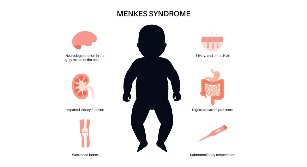 Ilustración de la enfermedad de Menkes, mostrando un bebé y sus síntomas: cabello plateado, problemas digestivos, neurodegeneración, riñones y huesos débiles, y temperatura corporal baja.