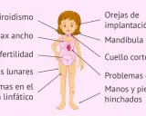 Ilustración de una niña con los **síntomas del síndrome de Turner**: hipotiroidismo, tórax ancho, infertilidad, lunares, problemas linfáticos, orejas bajas, mandíbula pequeña, cuello corto, problemas cardíacos y edema.