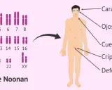 Cariotipo con anomalía en cromosoma 12, asociado a características del síndrome de Noonan: cara triangular, ojos separados, cuello ancho, criptorquidia y defectos en el pene.