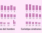 Cariotipo de hombre con cromosomas XY y cariotipo de síndrome de Klinefelter con XXY.