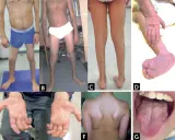 Manifestaciones de atrofia muscular espinal: piernas delgadas (A, B, C), pie equino (D), manos con dedos finos (E), espalda con escápulas prominentes (F) y lengua con fasciculaciones (G).
