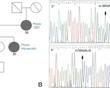 Pedigrí que muestra herencia mitocondrial de ptosis y hipoacusia, junto a electroforesis que confirma la mutación m.3243A>G.