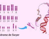 Cariotipo XY con el gen SRY afectado, indicativo del Síndrome de Swyer.