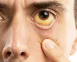 Ojo con esclerótica amarilla, indicativo de ictericia, posiblemente relacionada con sd Gilbert.