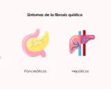 Ilustración de síntomas de fibrosis quística: respiratorios (tos, mucosidad), pancreáticos, hepáticos y reproductivos (azoospermia obstructiva).