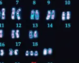 Cariotipo humano con 23 pares de cromosomas, incluyendo el par sexual X e Y. Se observan los cromosomas del 6 al 18, y el 21.