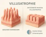 Comparación de vellosidades intestinales: sanas y atrofiadas. La atrofia vellositaria puede ser causada por la anti transglutaminasa.