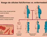 Ilustración compara rasgo de células falciformes (sin síntomas) con la enfermedad, causada por la mutación de anemia falciforme. Muestra células normales y falciformes.