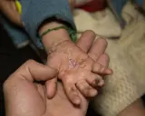Una mano adulta sostiene la mano de un niño con piel escamosa y seca, mostrando cómo empieza la piel de mariposa.