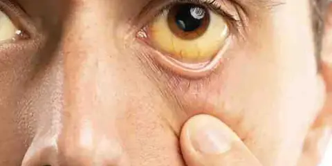 Ojo con esclerótica amarilla, indicativo de ictericia, posiblemente relacionada con sd Gilbert.