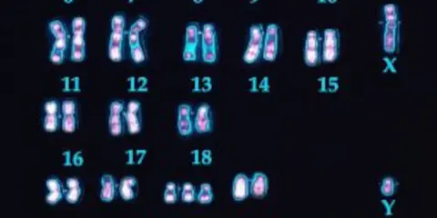Cariotipo humano con 23 pares de cromosomas, incluyendo el par sexual X e Y. Se observan los cromosomas del 6 al 18, y el 21.