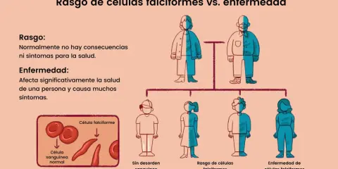 Ilustración compara rasgo de células falciformes (sin síntomas) con la enfermedad, causada por la mutación de anemia falciforme. Muestra células normales y falciformes.