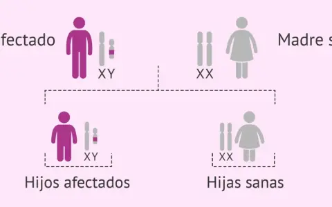 Padre afectado (XY) y madre sana (XX) tienen hijos afectados (XY) y hijas sanas (XX). El cromosoma Y determina el sexo masculino.