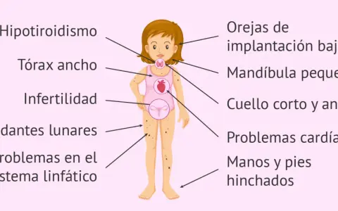 Ilustración de una niña con los **síntomas del síndrome de Turner**: hipotiroidismo, tórax ancho, infertilidad, lunares, problemas linfáticos, orejas bajas, mandíbula pequeña, cuello corto, problemas cardíacos y edema.