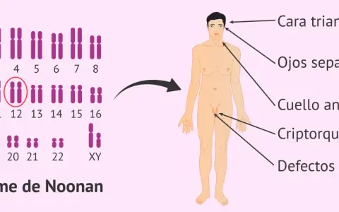 Cariotipo con anomalía en cromosoma 12, asociado a características del síndrome de Noonan: cara triangular, ojos separados, cuello ancho, criptorquidia y defectos en el pene.