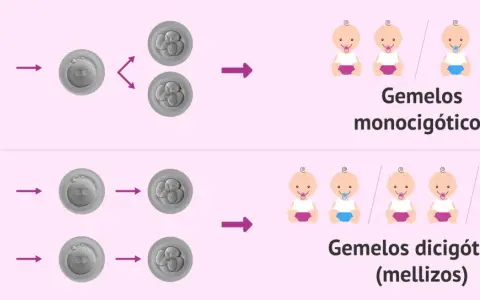 Ilustración de la concepción de gemelos. Los gemelos monocigóticos provienen de un óvulo y un espermatozoide, y pueden ser niño y niña. Los dicigóticos, de dos óvulos y dos espermatozoides.