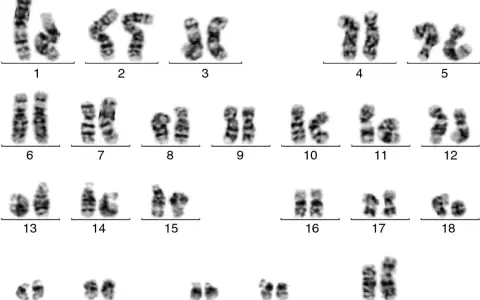 Cariotipo humano con 23 pares de cromosomas, incluyendo los autosomas del 1 al 22 y los cromosomas sexuales X e Y. Un análisis qf pcr revela la estructura de cada par.