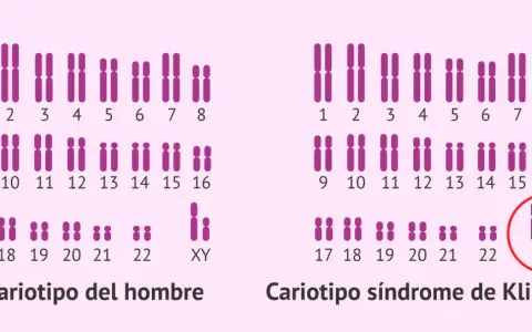 Cariotipo de hombre con cromosomas XY y cariotipo de síndrome de Klinefelter con XXY.