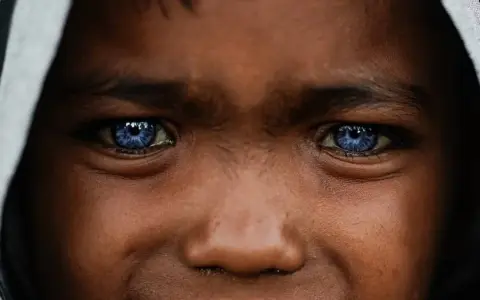 Ojos azules intensos, como el cielo, en un rostro joven. Podrían ser un rasgo distintivo del síndrome de Waardenburg, que a menudo se manifiesta con ojos de colores inusuales.
