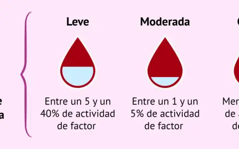 Ilustración de tipos de hemofilia: leve (5-40% actividad factor), moderada (1-5%) y grave (<1%).