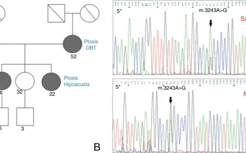 Pedigrí que muestra herencia mitocondrial de ptosis y hipoacusia, junto a electroforesis que confirma la mutación m.3243A>G.