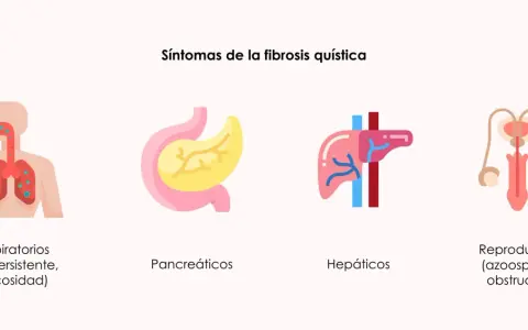 Ilustración de síntomas de fibrosis quística: respiratorios (tos, mucosidad), pancreáticos, hepáticos y reproductivos (azoospermia obstructiva).