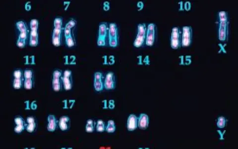 Cariotipo humano con 23 pares de cromosomas, incluyendo el par sexual X e Y. Se observan los cromosomas del 6 al 18, y el 21.