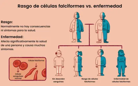Ilustración compara rasgo de células falciformes (sin síntomas) con la enfermedad, causada por la mutación de anemia falciforme. Muestra células normales y falciformes.