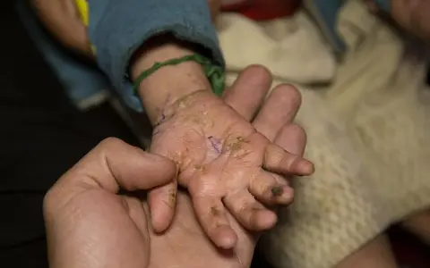 Una mano adulta sostiene la mano de un niño con piel escamosa y seca, mostrando cómo empieza la piel de mariposa.