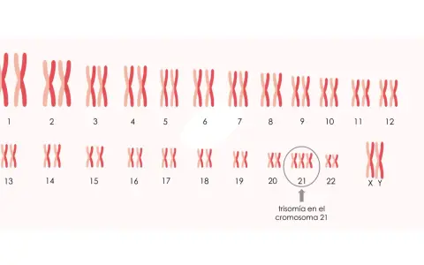 Cariotipo que muestra trisomía en el cromosoma 21, indicando cuántos cromosomas tiene un Down.