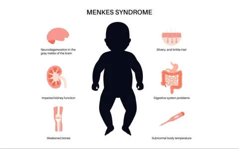 Ilustración de la enfermedad de Menkes, mostrando un bebé y sus síntomas: cabello plateado, problemas digestivos, neurodegeneración, riñones y huesos débiles, y temperatura corporal baja.