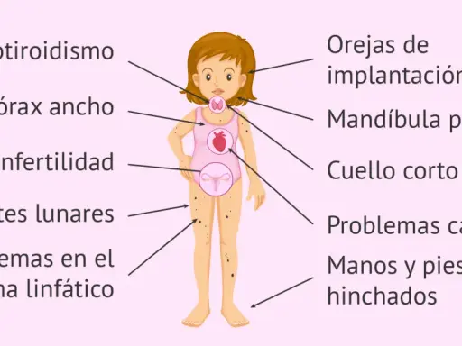 Ilustración de una niña con los **síntomas del síndrome de Turner**: hipotiroidismo, tórax ancho, infertilidad, lunares, problemas linfáticos, orejas bajas, mandíbula pequeña, cuello corto, problemas cardíacos y edema.