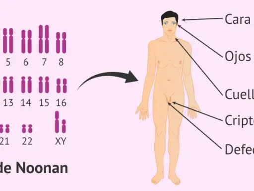 Cariotipo con anomalía en cromosoma 12, asociado a características del síndrome de Noonan: cara triangular, ojos separados, cuello ancho, criptorquidia y defectos en el pene.