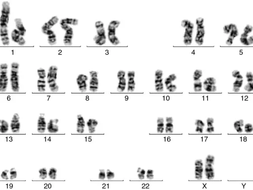 Cariotipo humano con 23 pares de cromosomas, incluyendo los autosomas del 1 al 22 y los cromosomas sexuales X e Y. Un análisis qf pcr revela la estructura de cada par.