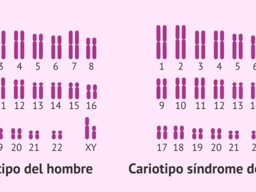 Cariotipo de hombre con cromosomas XY y cariotipo de síndrome de Klinefelter con XXY.
