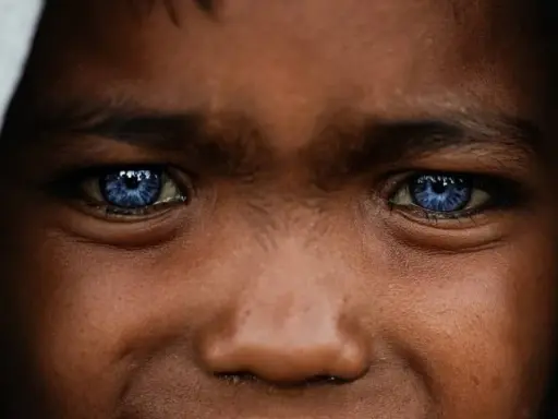 Ojos azules intensos, como el cielo, en un rostro joven. Podrían ser un rasgo distintivo del síndrome de Waardenburg, que a menudo se manifiesta con ojos de colores inusuales.