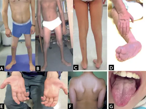 Manifestaciones de atrofia muscular espinal: piernas delgadas (A, B, C), pie equino (D), manos con dedos finos (E), espalda con escápulas prominentes (F) y lengua con fasciculaciones (G).